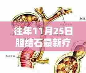 揭秘胆结石最新疗法，科技引领医疗革新，历年进展回顾（往年11月25日）