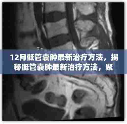 揭秘骶管囊肿最新治疗方法，聚焦十二月医学进展，为患者带来福音